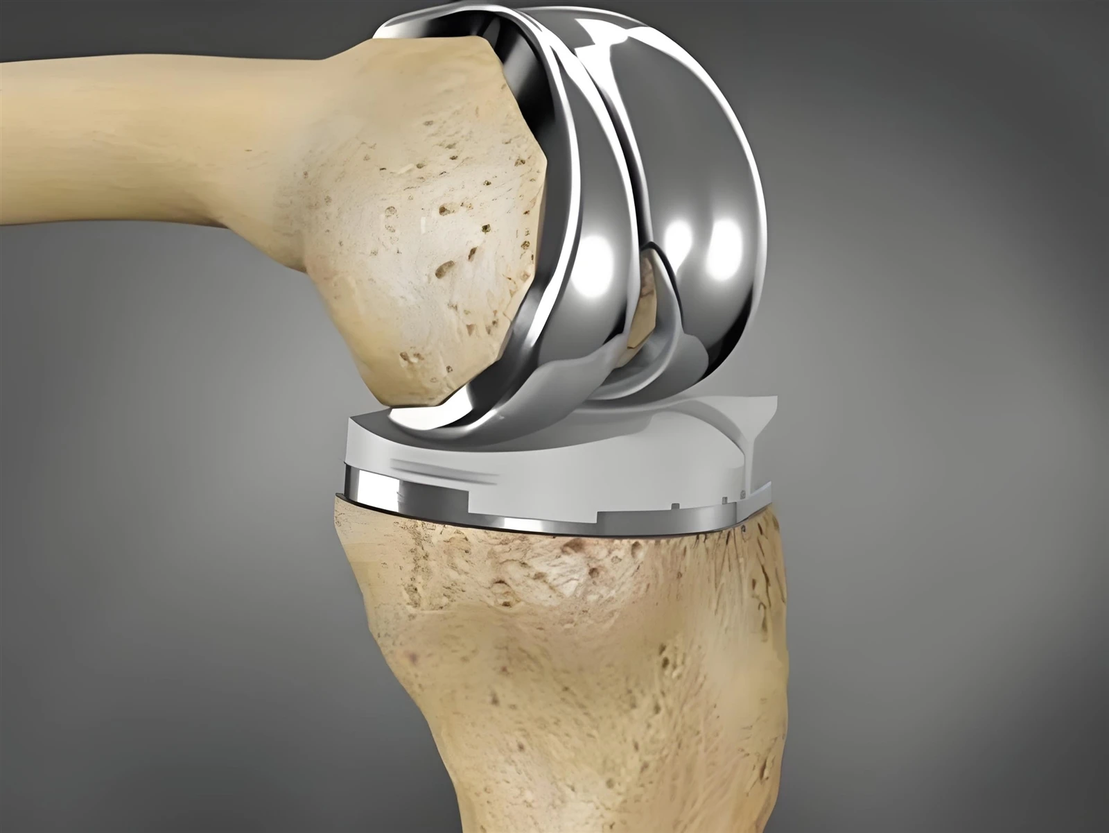 Titanium In Transplants Titanium In Transplants