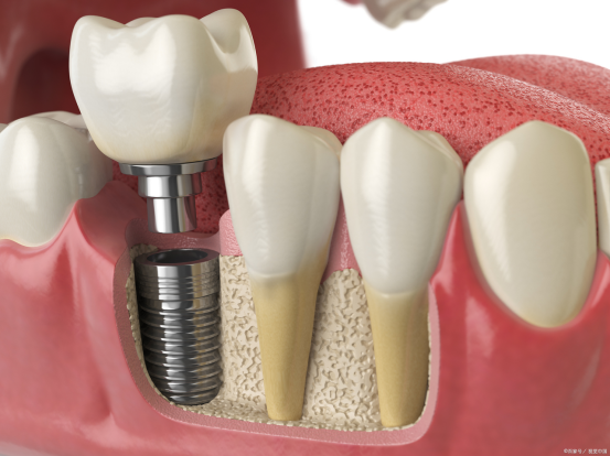 implant titanium implant titanium